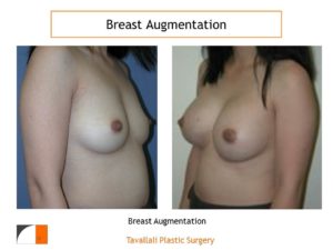 Breast enlargement surgery with implants