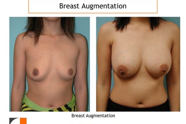 Breast enlargement with saline implants VA