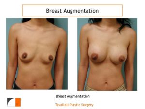 Breast enlargement to size B cup with implant