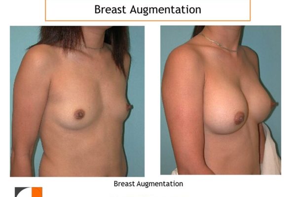 Breast enlargement to size C cup with implants