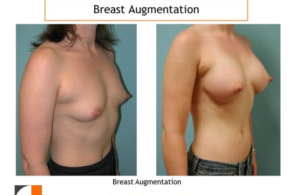 Breast augmentation cup c before after