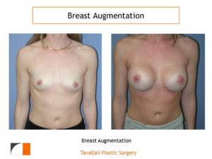 Breast augmentation before and after VA