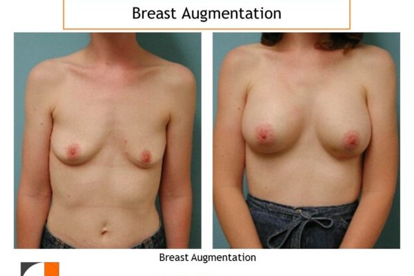 Breast enlargement in woman with small breasts