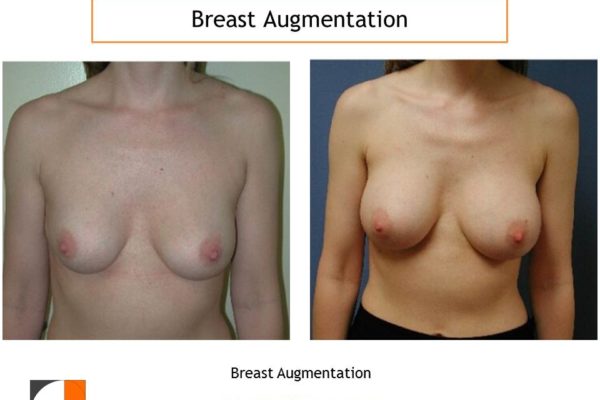 Befora and after of breast augmentation with implants