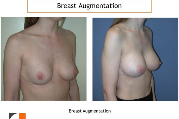 Breast enlargement before after with saline implants