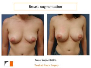 Breast augmentation saline implants intra areolar scar