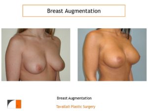 Breast enlargement high profile saline implants