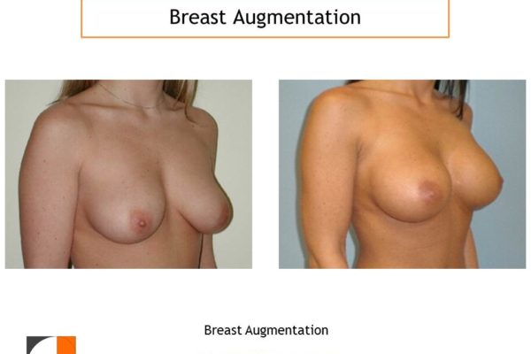 Breast enlargement high profile saline implants