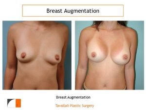 Breast augmentation surgery before after result