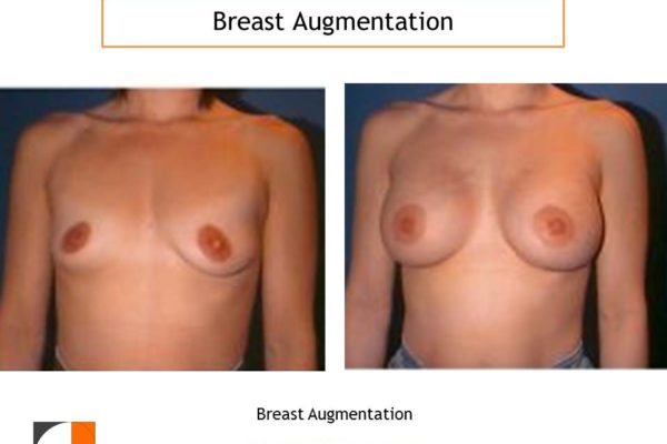 Breast augmentation before after in woman with two breast sizes