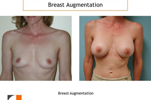 Breast augmentation silicone implants before after