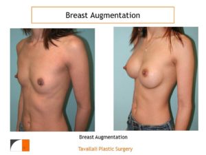Flat chest breast augmentation before after with implants