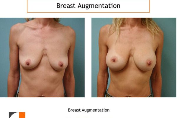 Droopy breasts with breast augmentation with silicone implants