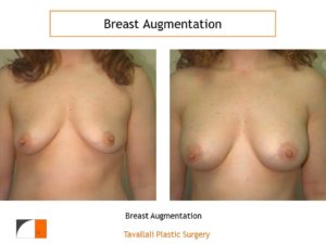 small saline implant breast augmentation