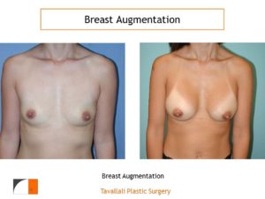 small saline implants for breast enlargement