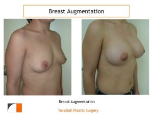 Breast enlargement surgery result