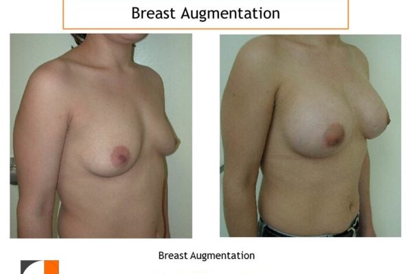 Breast enlargement surgery result