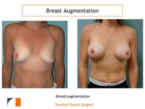 Small breast augmentation before after