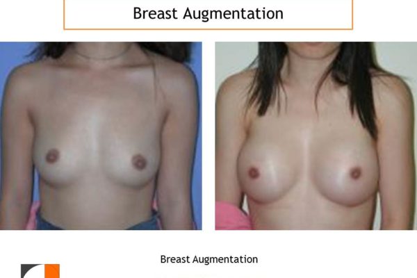 Early breast augmentation result with saline implants
