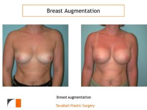 Breast augmentation surgery with implants