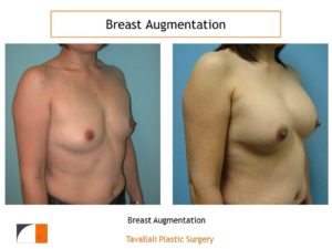 Breast augmentation in northern Virginia