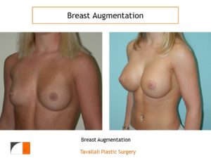 Breat augmentation with implants in northern VA