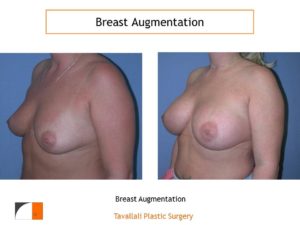 Breast enlargement with saline implants VA