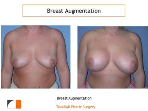 Breast augmentation with large implants northern VA