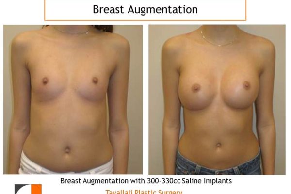 300-330 cc saline implants for breast surgery