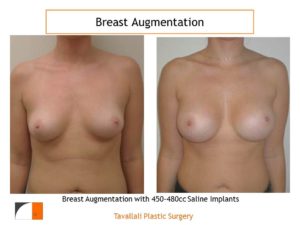 breast enlargement before and after saline implants 450-480 cc