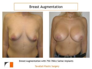 Breast augmentation surgery with 750-780 cc before after
