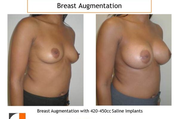 Breast augmentation saline implant with 420cc-450cc