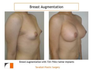 720-750 cc saline implants for breast enlargement result