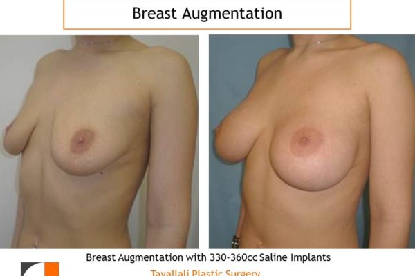 Saline implants 330-360cc for enlargement