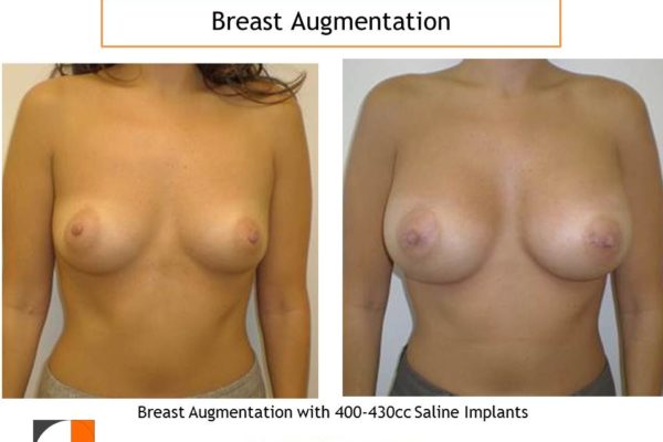 Breast augmentation before and after 400 cc-430 cc saline implants