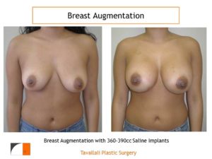 360-390 cc saline implants breast augmentation surgery