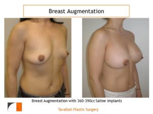 Breast augmentation with 360-390 cc saline implants