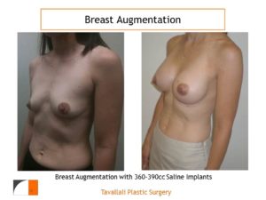 Breast enlargement with 360-390 cc saline implants