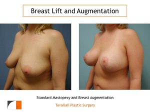 Standard mastopexy lift and breast augmentation