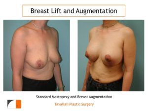 Breast augmentation at same time as breast lift results