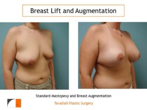 Breast lift and enlargement with saline implant in woman with different sized breasts