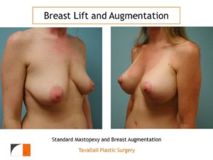 Breast lift surgery and breast augmentation surgery results