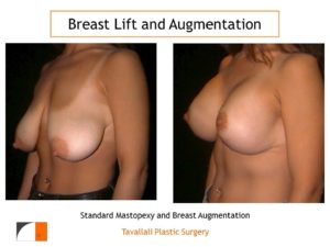 Breast lift mastopexy with enlargement of breast silicone implants