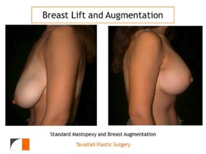 Breast lift and augmentation result Dr. Tavallali