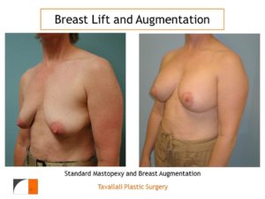 Breast augmentation and lift mastopexy before after result
