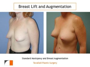 Breast lift with small breast augmentation with implants
