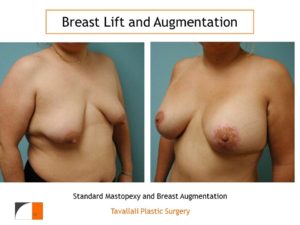 Breast lift augmentation surgery result