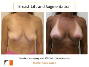 Standard breast lift mastopexy with 330 cc saline implant enlargement