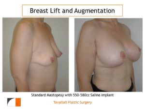 Breast lift and breast augmentation with 550-580 cc saline implants