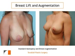 Breast lift mastopexy and augmentation of breast before after